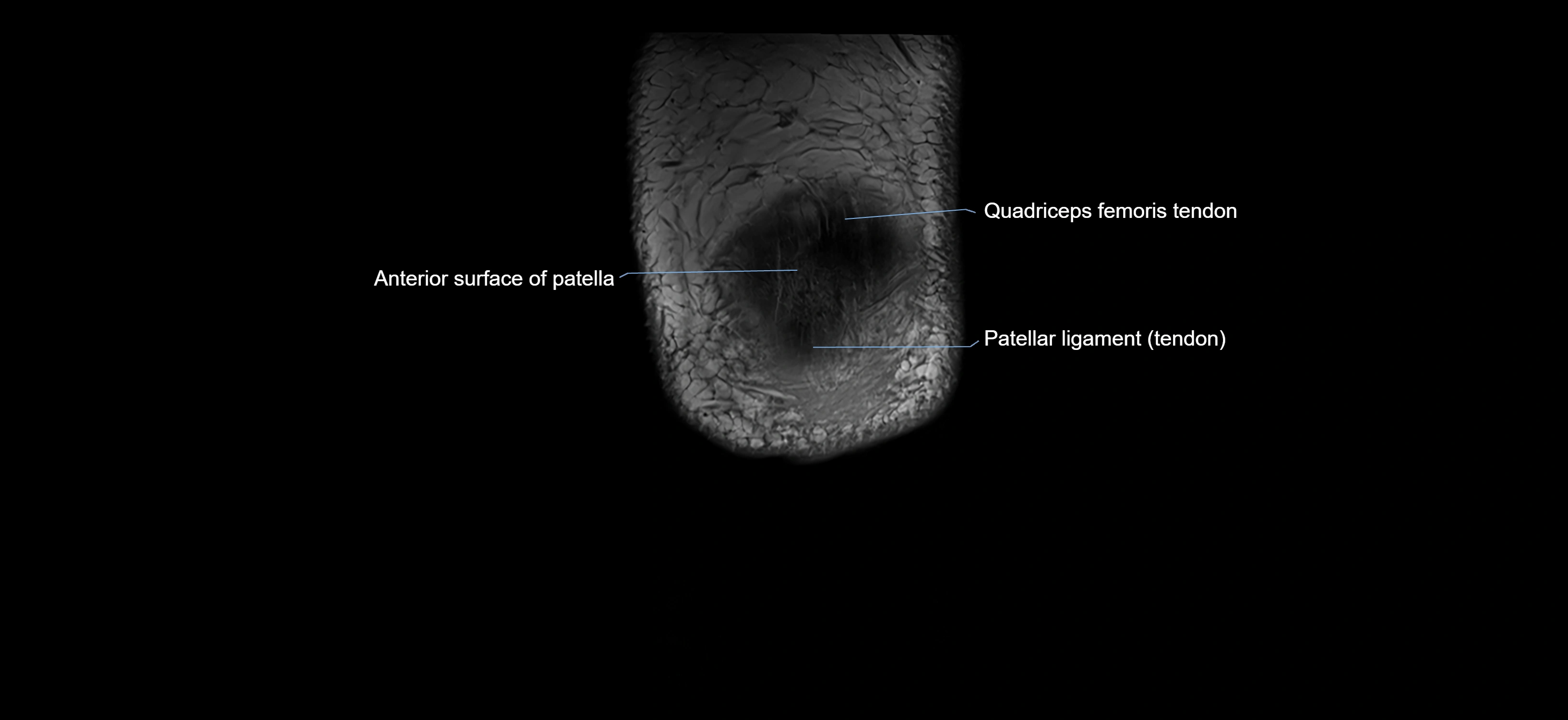 MRI knee coronal cross sectional anatomy labelled 3T radiology  image-04001-00002.webp